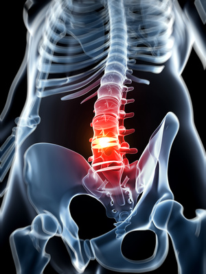 what is a herniated disc