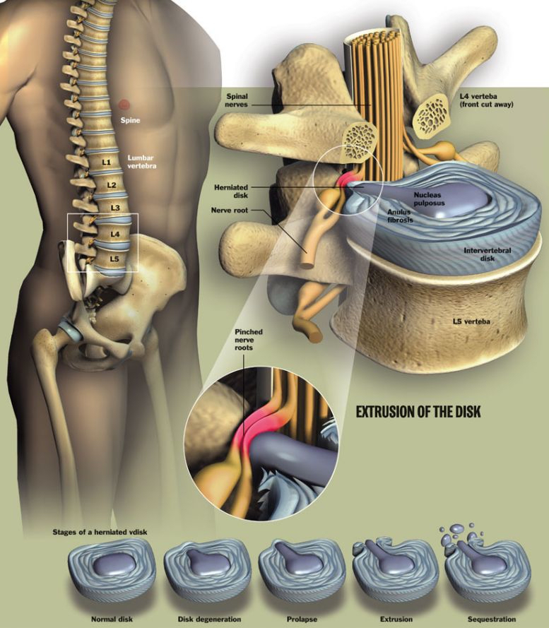 Slipped Disk Causes, Symptoms & Treatments A I R I E F site